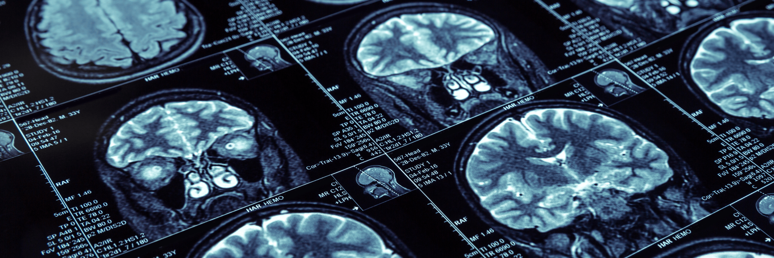 COVERY_1-65ce2b54 Lecanemab – kamień milowy w walce z chorobą Alzheimera?